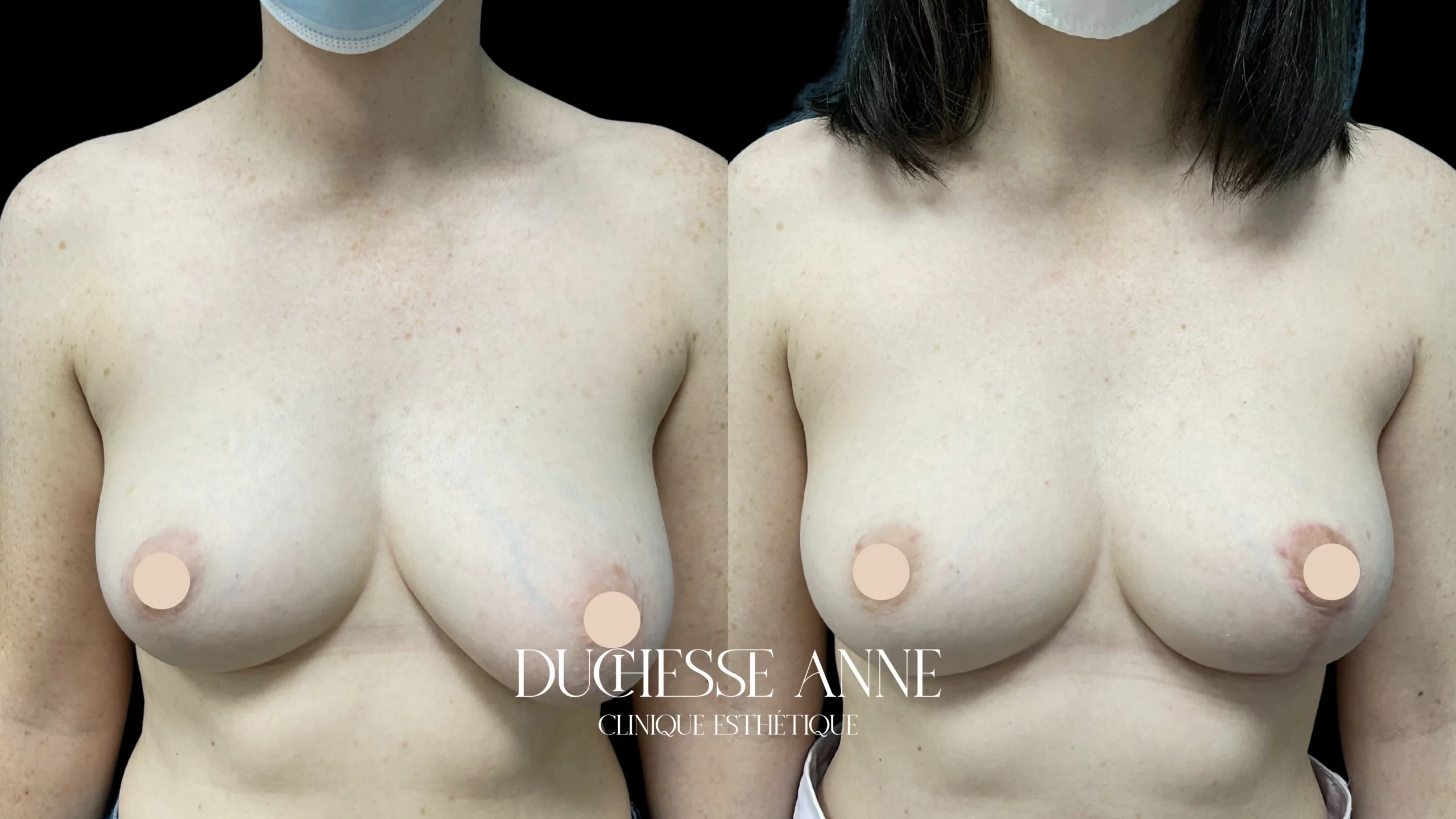 correction asymétrie mammaire - clinique duchesse anne
