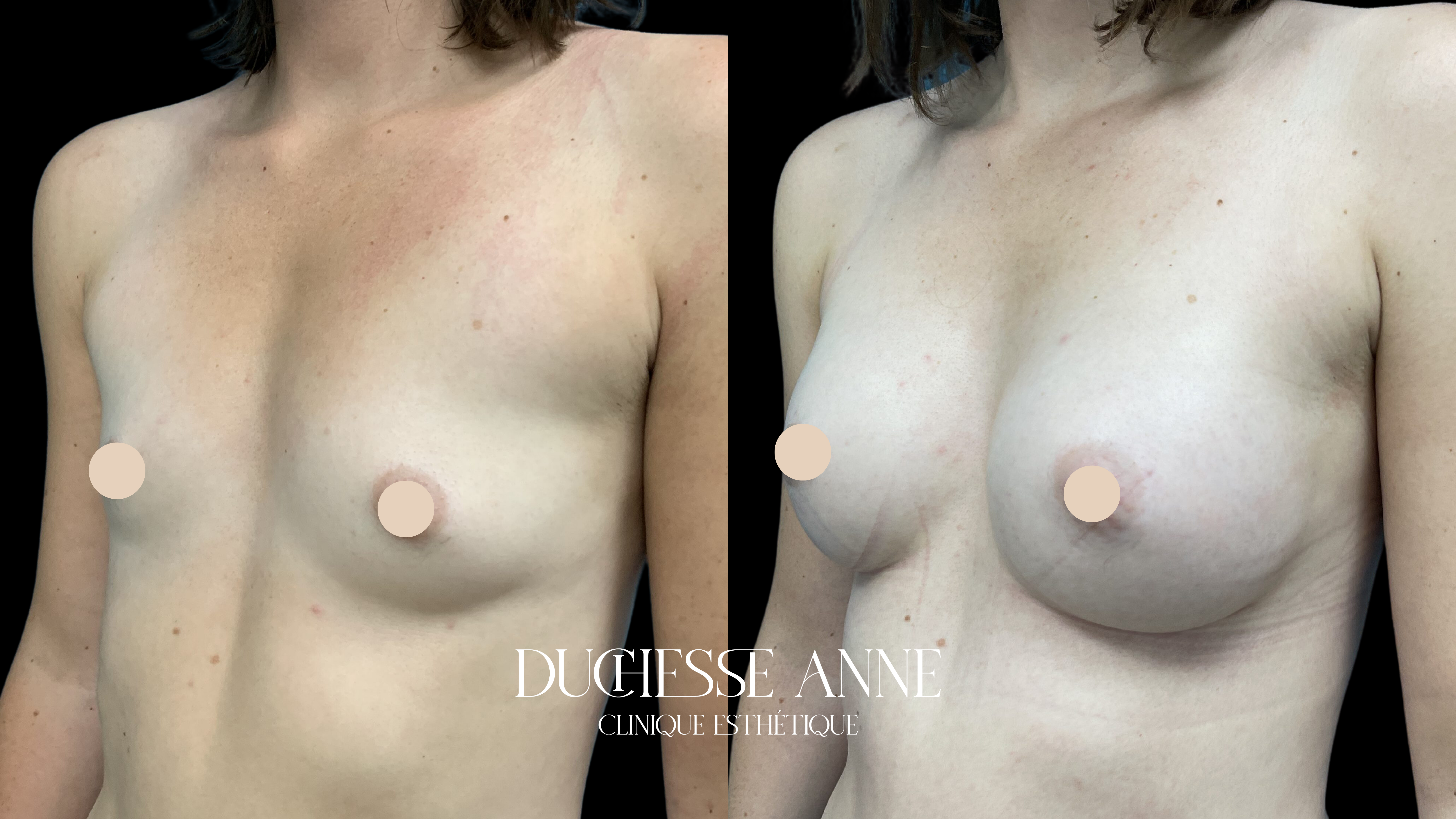 Augmentation mammaire prothèses clinique duchesse anne
