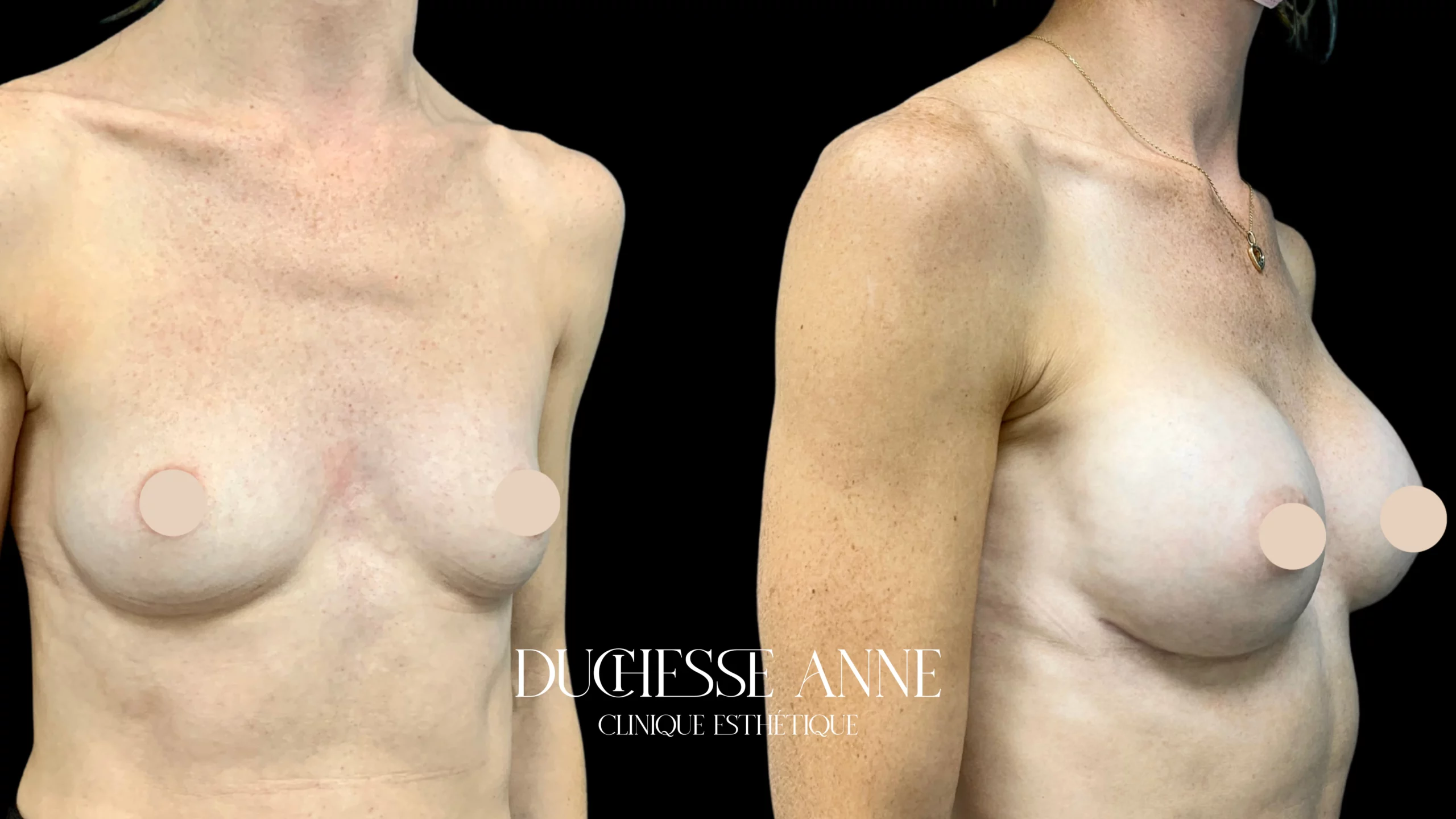 Augmentation mammaire par prothèses Clinique Duchesse Anne Rennes