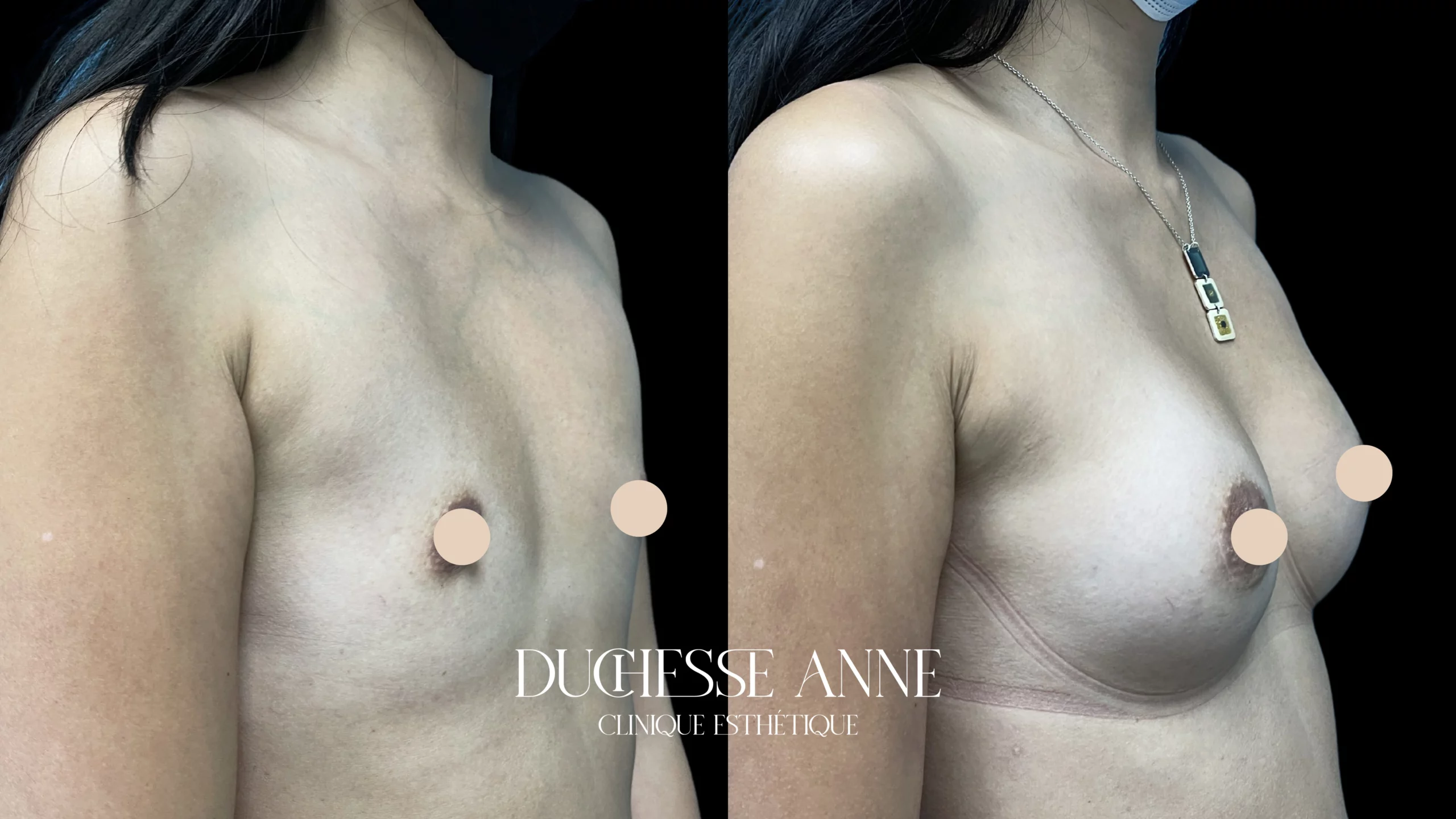 reconstruction mammaire clinique duchesse anne