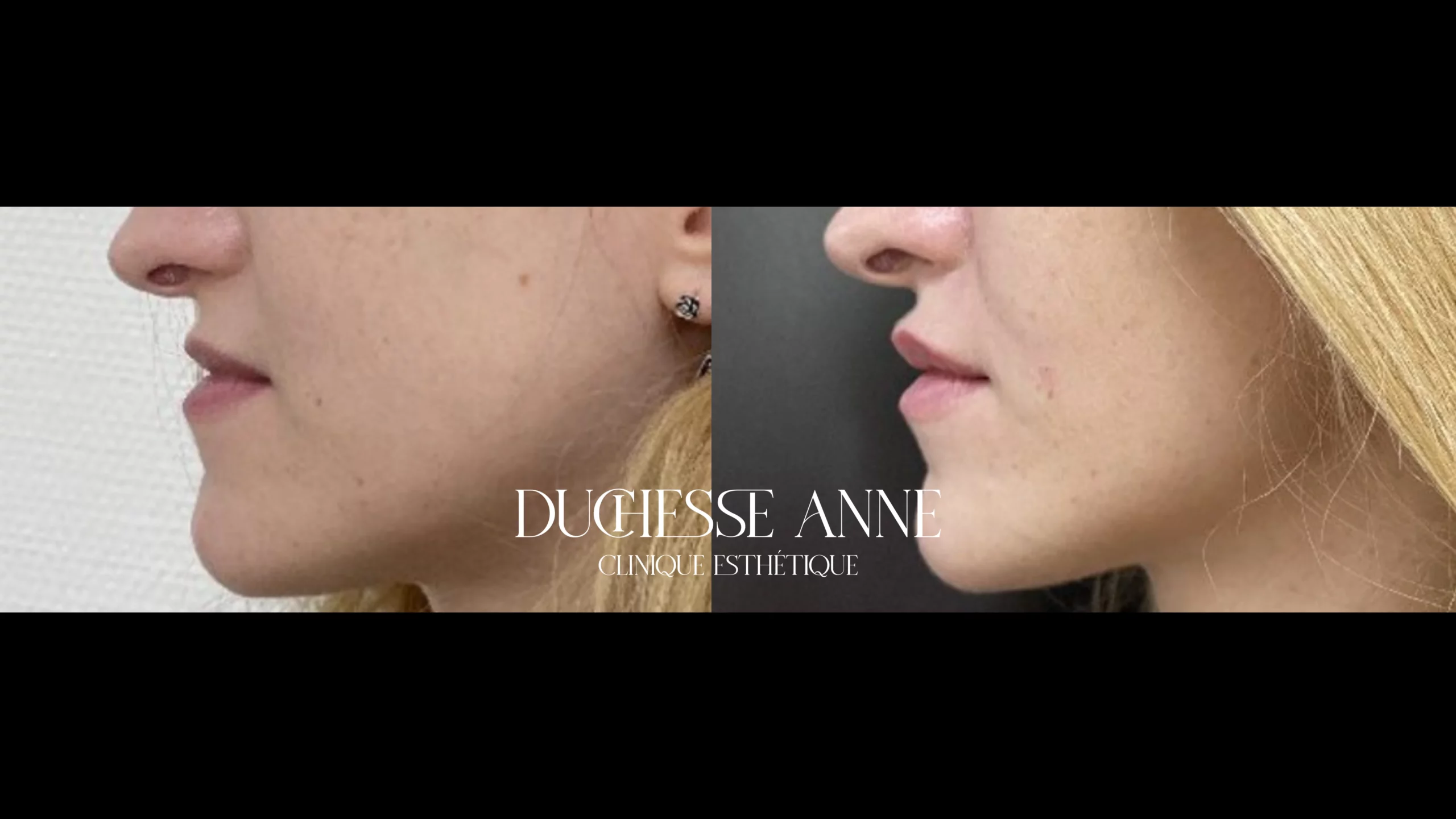 augmentation des lèvres clinique duchesse anne
