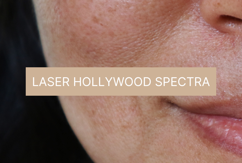 Laser Hollywood Spectra